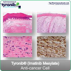 imatinib mesylate - acute myeloid Leukaemia and soft tissue sarcoma